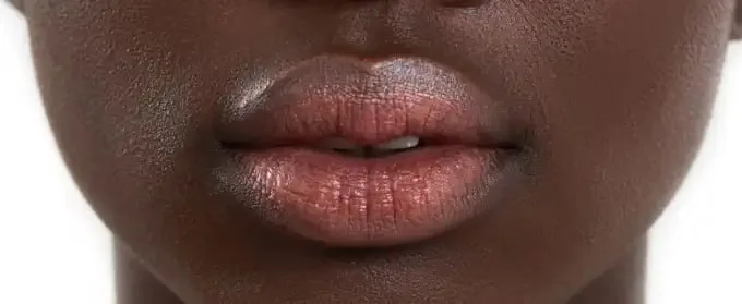 Dark Lip Pigmentation Service Dubai
